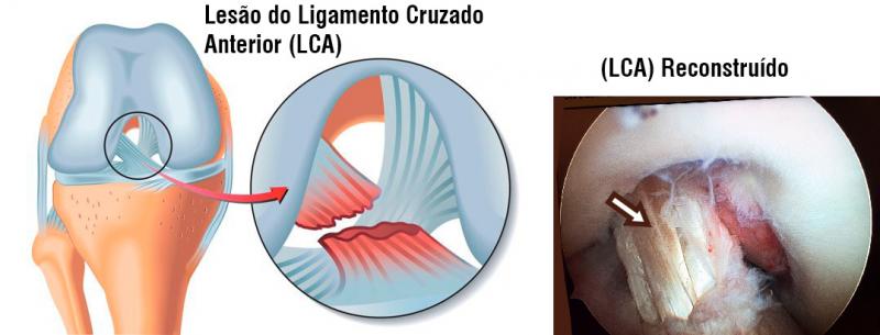 Quais os critérios para voltar a jogar futebol após a cirurgia de LCA  (ligamento cruzado anterior)